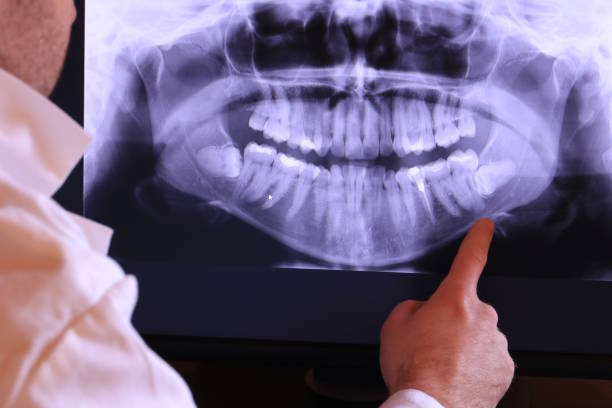 Best Knocked-Out Tooth (Avulsed Tooth) Treatment in Samson, AL